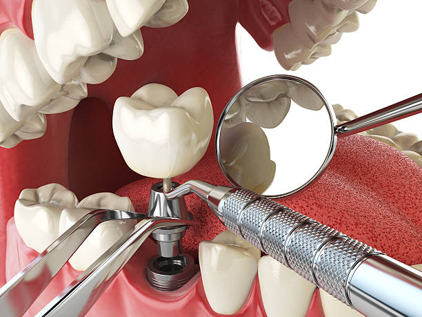 Best Emergency Wisdom Tooth Extraction in Atascocita, TX